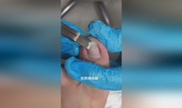 甲沟炎修脚视频,专业指导，轻松告别脚部困扰