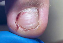 甲沟炎修脚视频,专业指导，轻松告别脚部困扰